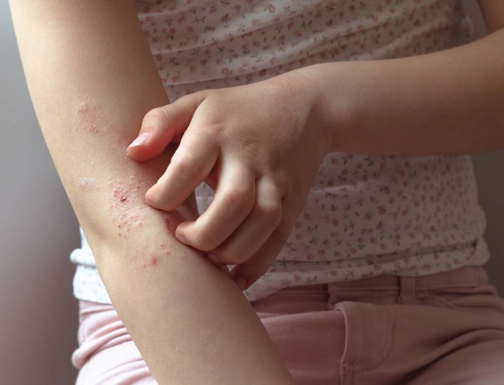 El virus coxsackie está en El Salvador, ¿qué es?